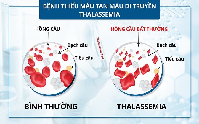 Image: Chung tay đẩy lùi bệnh Tan máu bẩm sinh - Vì sức khỏe dòng máu Việt